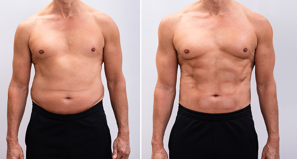 GLP-1 Drugs and Muscle Loss